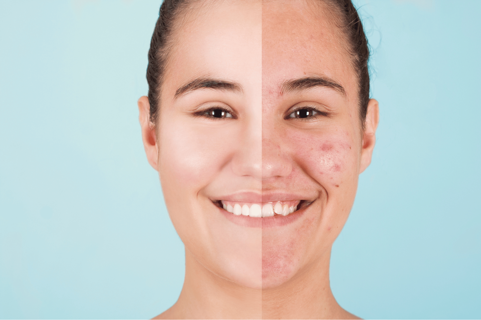 Gli effetti dell’alcool sulla pelle: pelle infiammata, acne